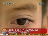 UB: Sore eyes, kumakalat tuwing tag-init