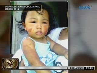 24 Oras: Batang may arthritis, nangangailangan ng tulong medikal