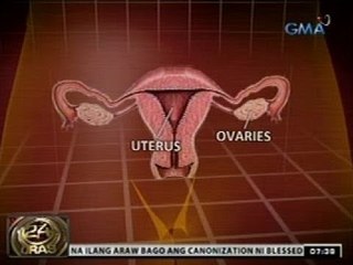 24 Oras: Napoles, tinanggalan ng matris at mga obaryo dahil sa dami ng bukol
