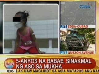 UB: 5-anyos na babae, sinakmal ng aso sa mukha