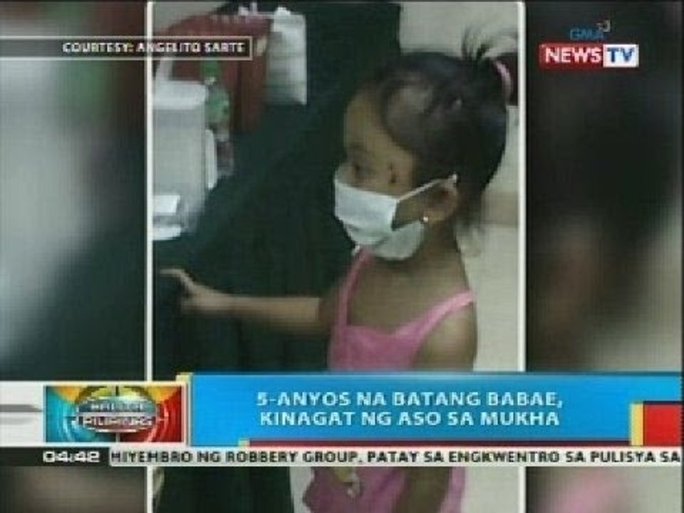BP: 5-anyos na batang babae, kinagat ng aso sa mukha