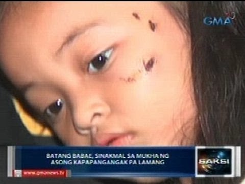 Saksi: Batang babae, sinakmal sa mukha ng asong kapapanganak pa lamang