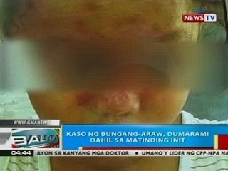 BP: Kaso ng bungang-araw, dumarami dahil sa tumitinding init