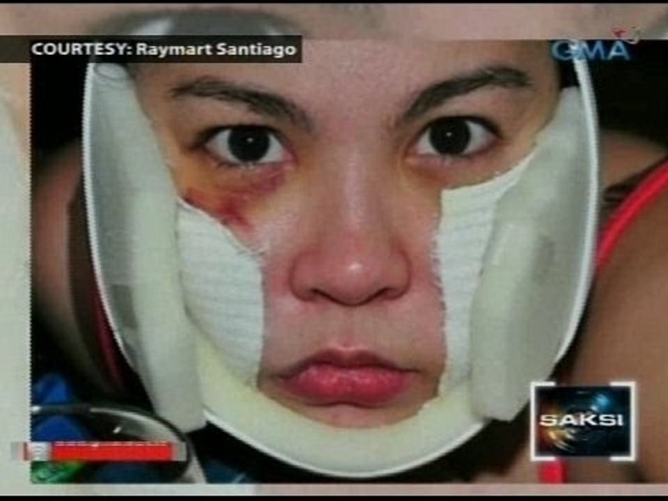 Saksi: Kampo ni Raymart: Dahil sa "post-surgical procedure" ang mga pasa ni Claudine