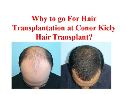 About Dr Conor Kiely Reviews | Conor kiely Hairtransplant
