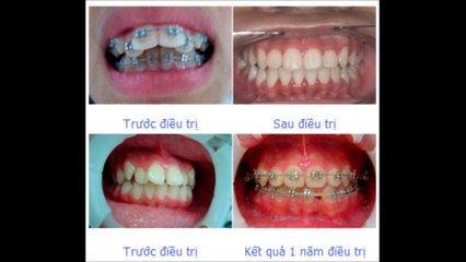 Nhakhoamedita.vn | Tẩy trắng răng hết bao nhiêu tiền tại hà nội