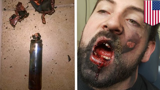 Vapist suffers second-degree burns, loses 7 teeth in vape pen explosion