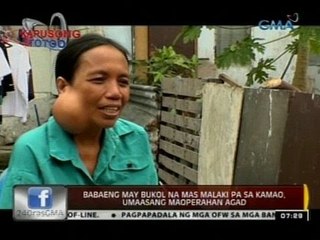 24 Oras: Babaeng may bukol na mas malaki pa sa kamao, umaasang maoperahan agad