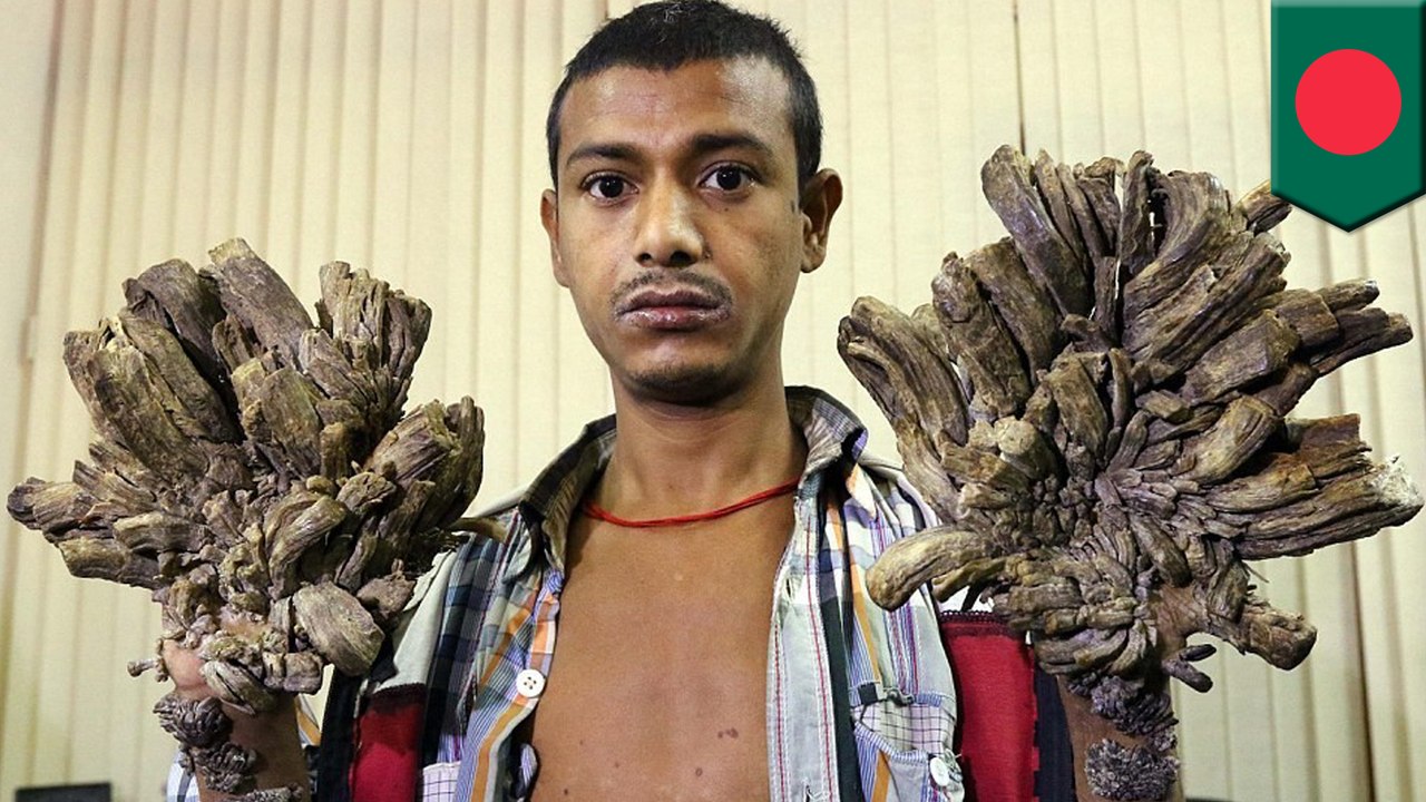 バングラデシュの ツリーマン 16回の手術で本来の手を取り戻す 動画 Dailymotion