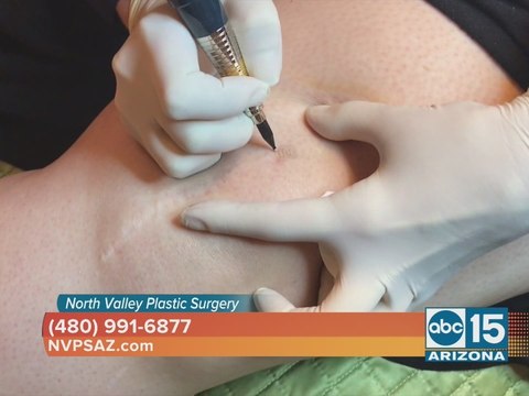 North Valley Plastic Surgery helps get rid of unwanted scars with paramedical tattooing
