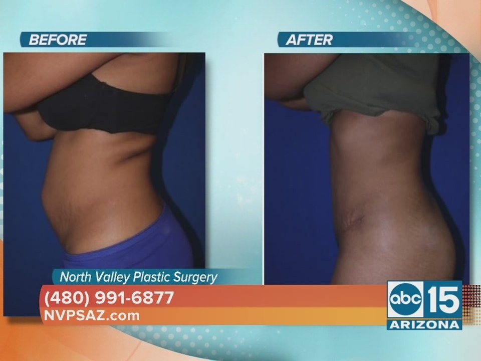 North Valley Plastic Surgery offers a tummy tuck that promises amazing results