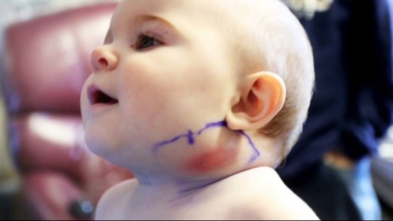 Feather Pulled From Baby Mya Whittington's Neck By Doctors
