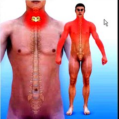 Cervical Spinal Stenosis or Myelopathy