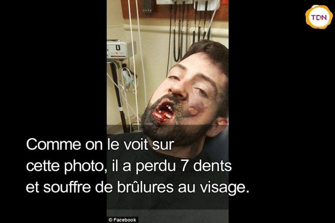 Regardez les dégats d'une cigarette électronique qui t'explose au visage