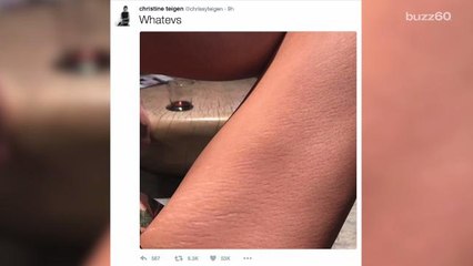 Chrissy Teigen Loves and Shares Her Stretch Marks