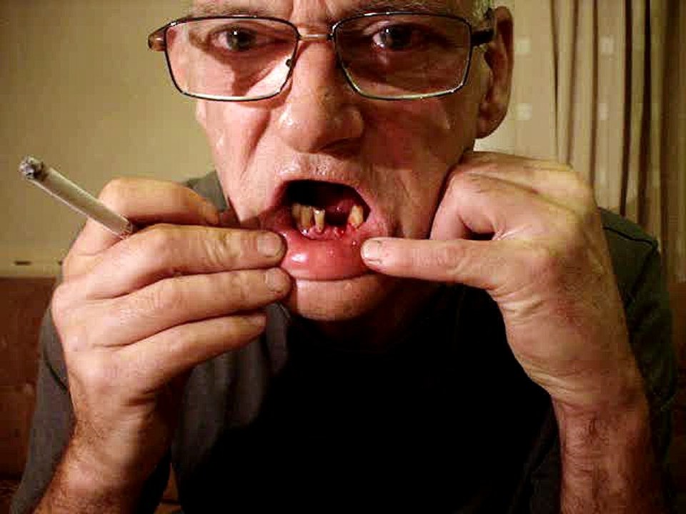 DIY Tooth Extraction 2
