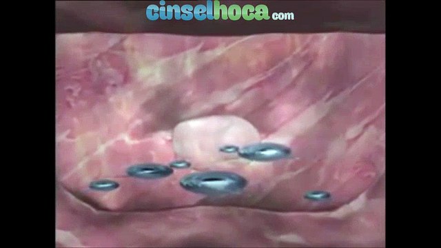 Kürtaj, Kürtaj Nedir Nasıl Yapılır, Kürtaj Fiyatları, Kürtaj Sonrası, Gebelik Sonlandırma | cinselhoca.com