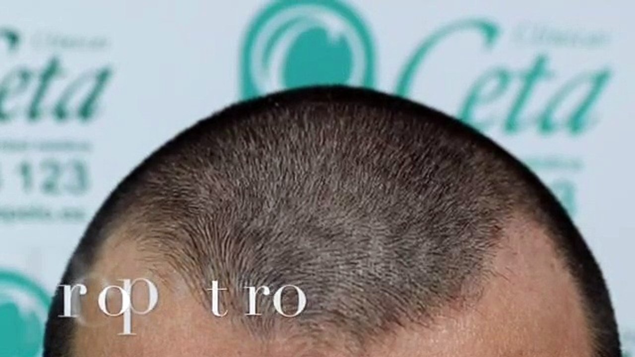 CLINICAS CETA CAPITAL www.injertodepelo.es