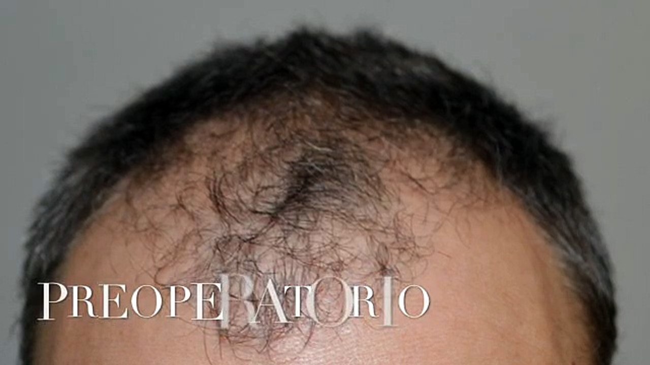 CLINICAS CETA CAPITAL www.injertodepelo.es