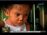 24 Oras: Batang may malnutrisyon at sakit sa balat, gumaling na