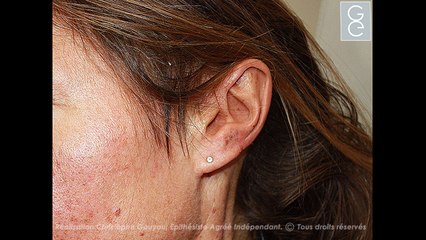 Les épithèses de pavillons : laboratoire d'épithèses faciales Gauyau