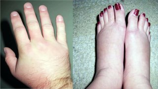 Why More And More People Wake Up With Swollen Arms And Feet