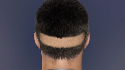 هذا الصباح.. وداعا للصلع مع أحدث تقنيات زراعة الشعر