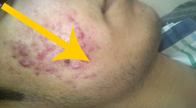 Facial Hair – Egg Mask to Removal Unwanted Hair on Your Face