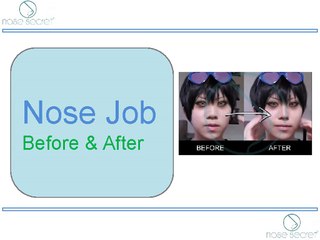 Nose Job Before & After - Nose Secret