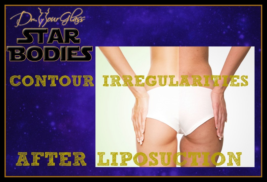 Contour irregularities after liposuction