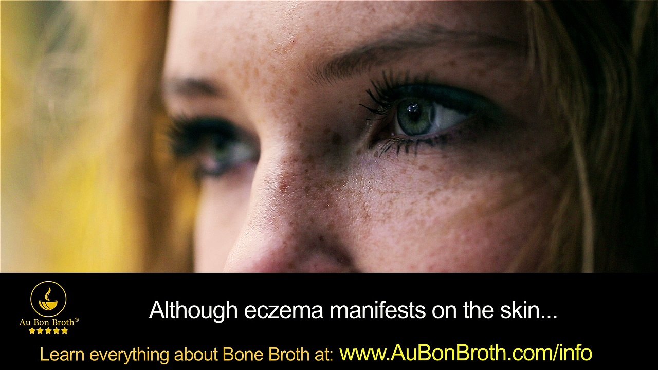 Natural Healing Remedies for Eczema by Balancing the Gut & Digestion