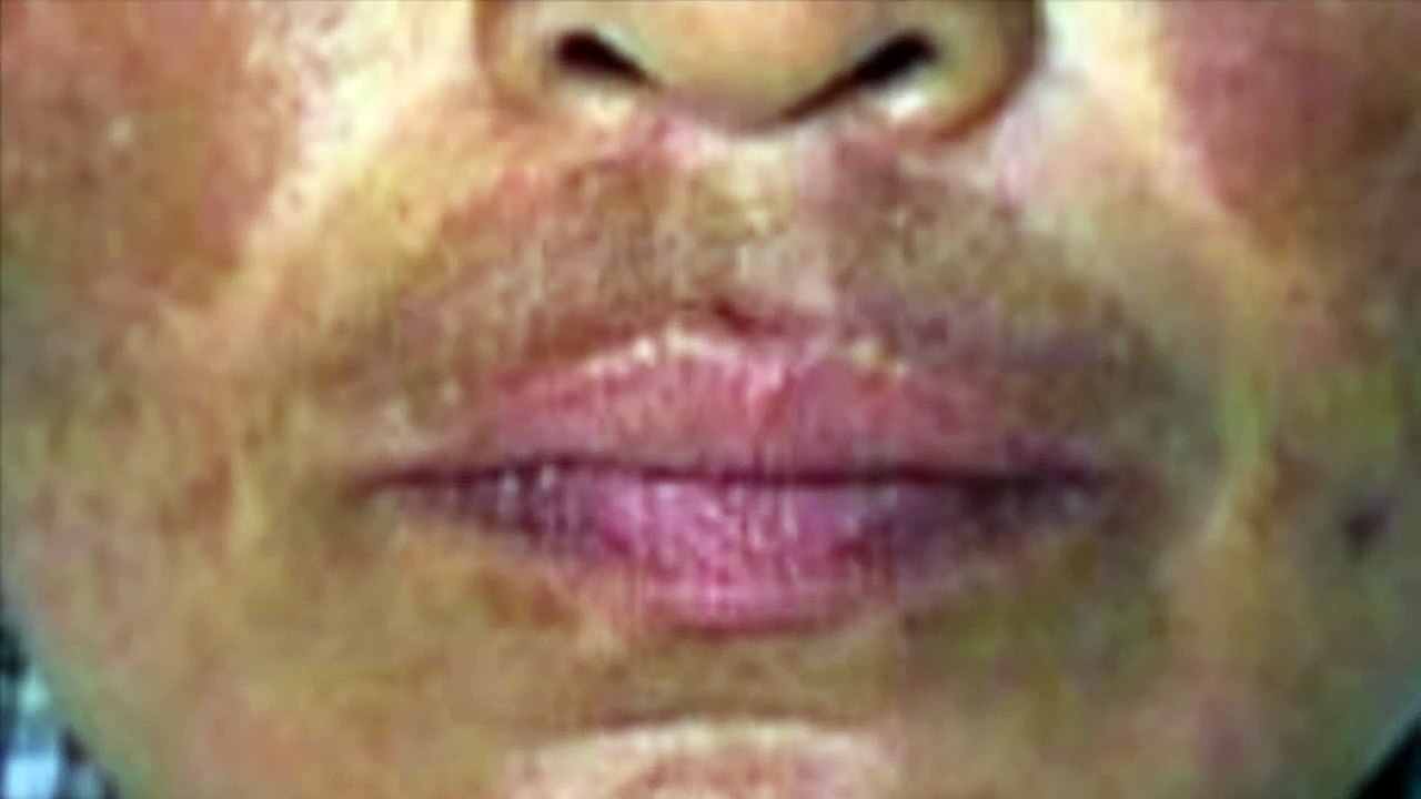 Melasma Manchas na Pele Dica Caseira Funciona? Parte 1