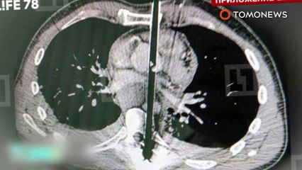 이 놈의 끈질긴 목숨? 한 러시아 남성, 자살하려 화살 두 방 맞고도 살아남아