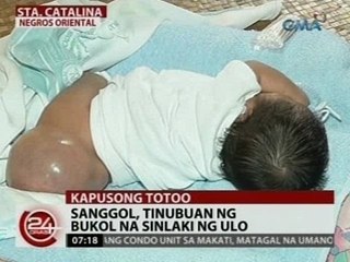 24 Oras: Sanggol, tinubuan ng bukol na sinlaki ng ulo
