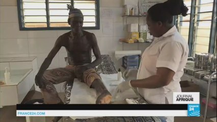 Bénin : la lèpre touche encore entre 150 et 200 personnes par an