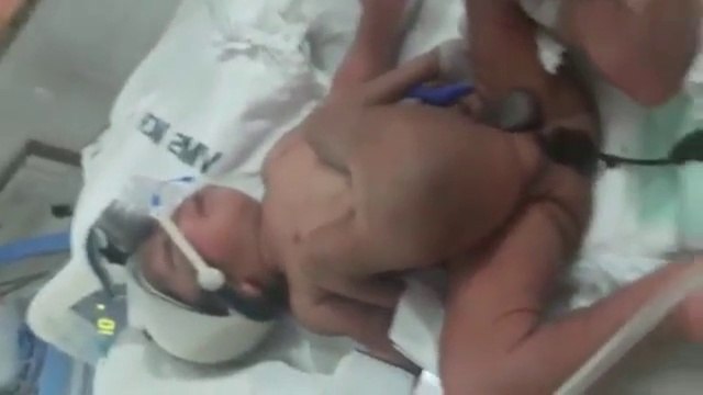 Un enfant naît avec 4 jambes et 2 pénis