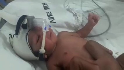 Un nouveau-né avec 4 jambes et 2 pénis