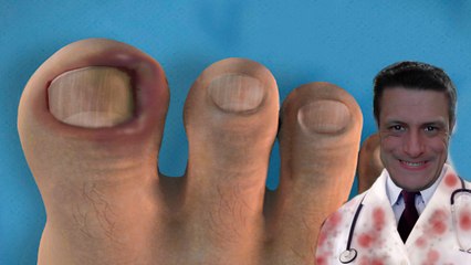 Como remover unha encravada