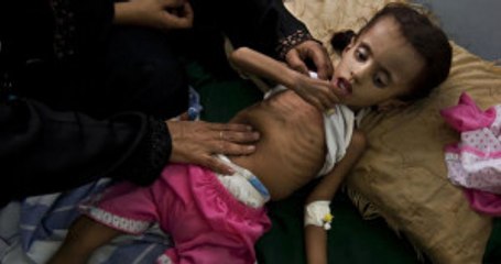BM: Her 10 Dakikada Bir, Yemen'de Bir Çocuk Açlıktan veya Hastalıktan Ölüyor