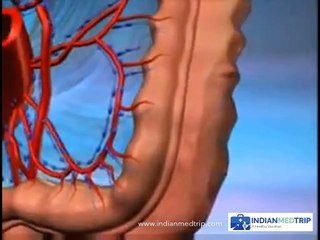 What Are the Symptoms of Colon Cancer & its Treatment? | MediClan