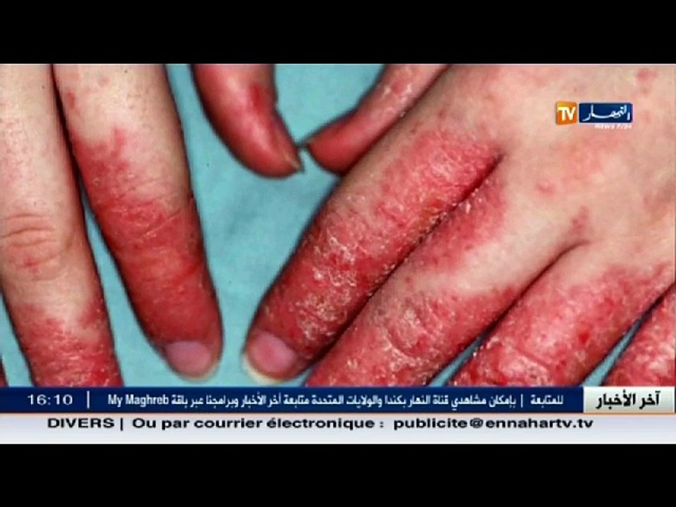 3 دقائق صحة   الإكزيما .... أشكالها ... مسبباته...