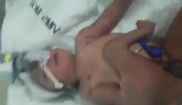 Un bébé naît avec 4 jambes et 2 pénis