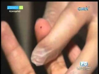 How to find out if you have food intolerance | Pinoy MD