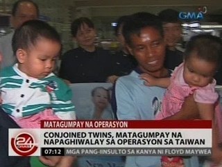 24 Oras: Conjoined twins, matagumpay na napaghiwalay sa operasyon sa Taiwan