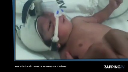 Inde : Un bébé naît avec 4 jambes et 2 pénis (vidéo)