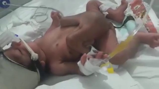 Cet enfant mal-formé naît avec 2 pénis et 4 jambes
