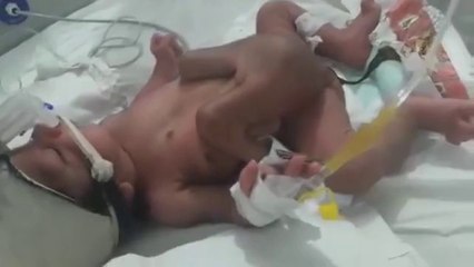 Cet enfant mal-formé naît avec 2 pénis et 4 jambes