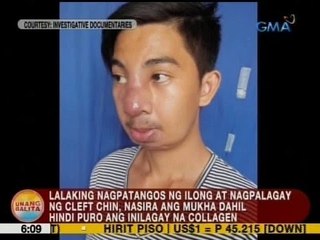 UB: Lalaking nagpatangos ng ilong at nagpalagay ng cleft chin, nasira ang mukha