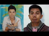 Teenager's face gets deformed after getting operated by fake nurse | Investigative Documentaries