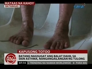 24Oras: Batang nagsugat ang balat dahil sa skin asthma, nangangailangan ng tulong
